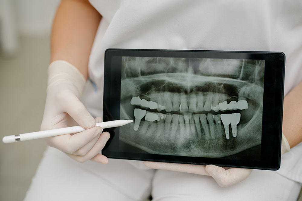 zahnarzt-holzkirchen- implantologie